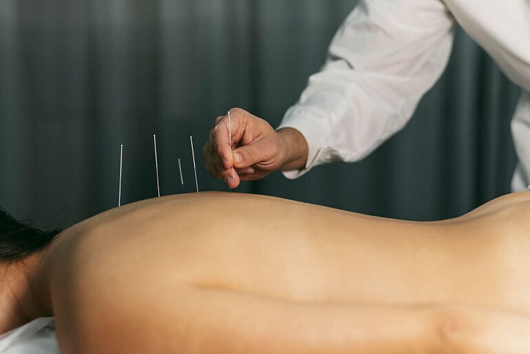 Top 05 Things to Avoid After Acupuncture